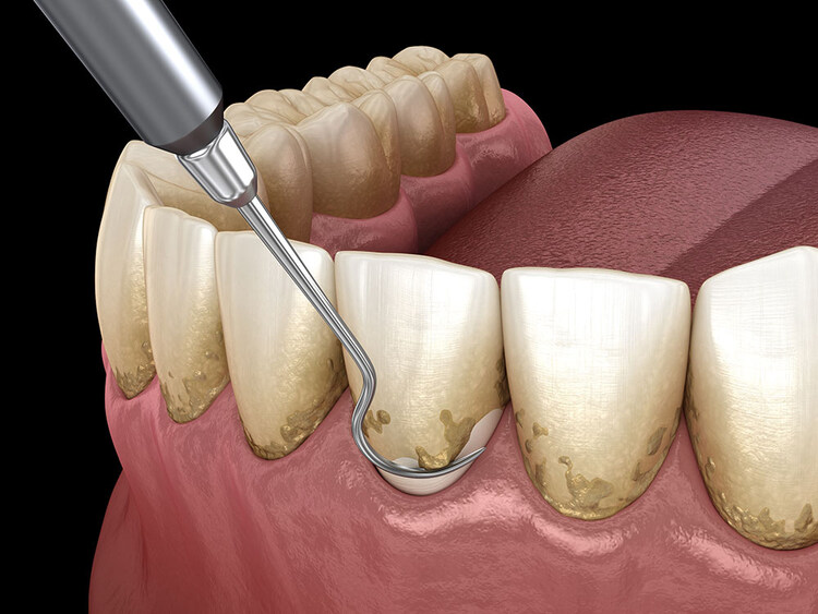 Illustration of teeth undergoing scaling and root planing procedure, showing dental instruments removing plaque and tartar below the gumline.