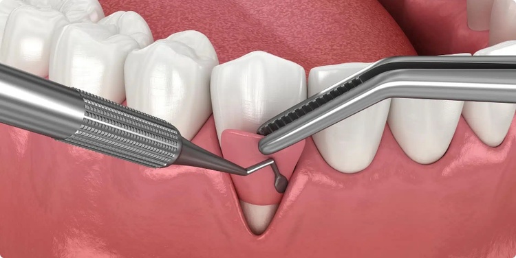 Illustration of gum grafting procedure showing gum tissue being transplanted to repair receding gums around teeth.