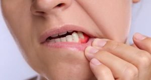 Close-up of infected tooth abscess and inflamed gums