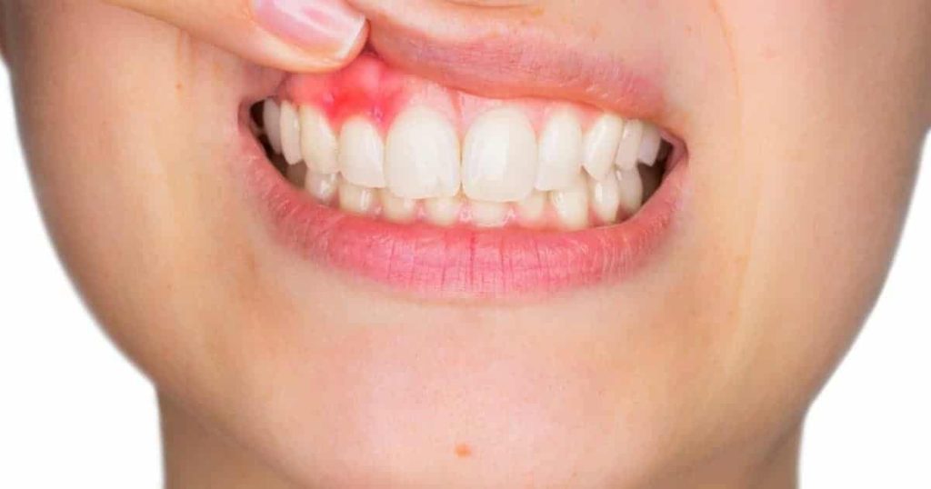 Woman lifting upper lip to show abscessed tooth and inflamed gums