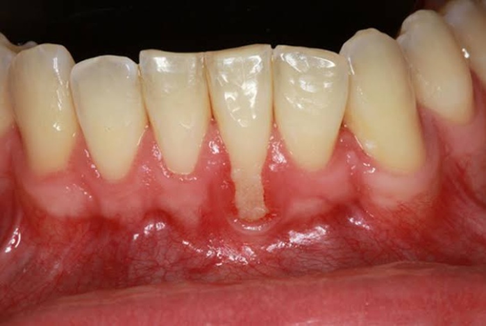 Close-up of the lower teeth with one tooth showing severe gum recession and a clearly exposed root surface.