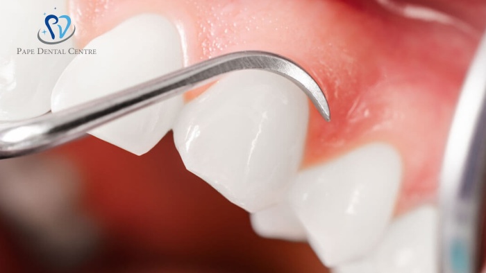 Close-up of a dentist performing scaling and professional dental cleaning on a patient's teeth as a non-surgical treatment for gum recession.