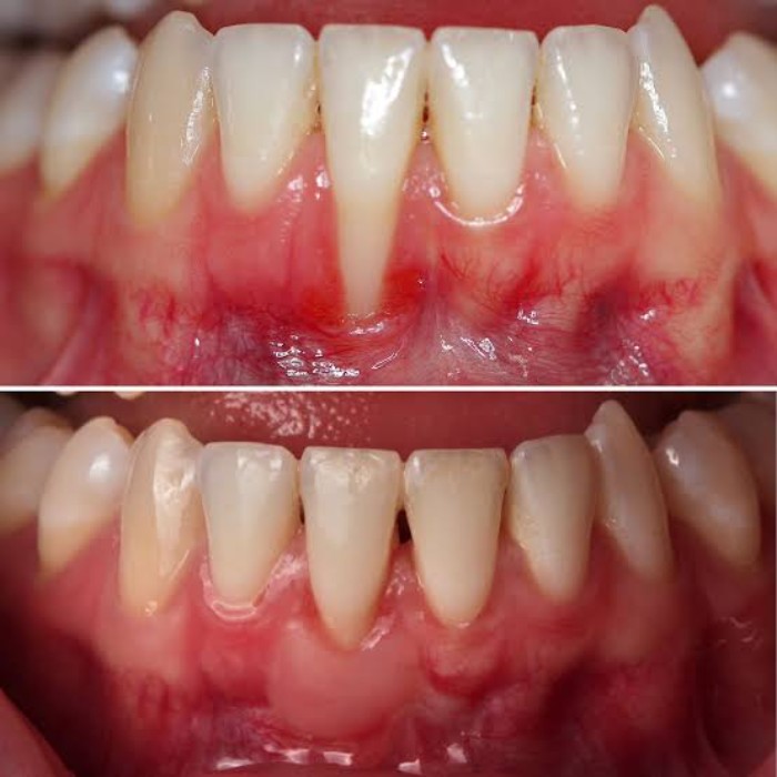 Before-and-after results of gum graft surgery showing improved gum coverage and reduced root exposure.