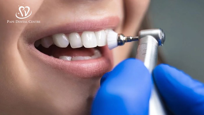 Close-up of a routine dental cleaning procedure for preventing gum recession.