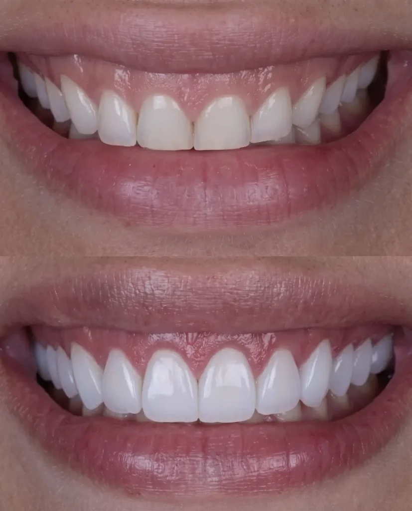 Cosmetic Dental Contouring