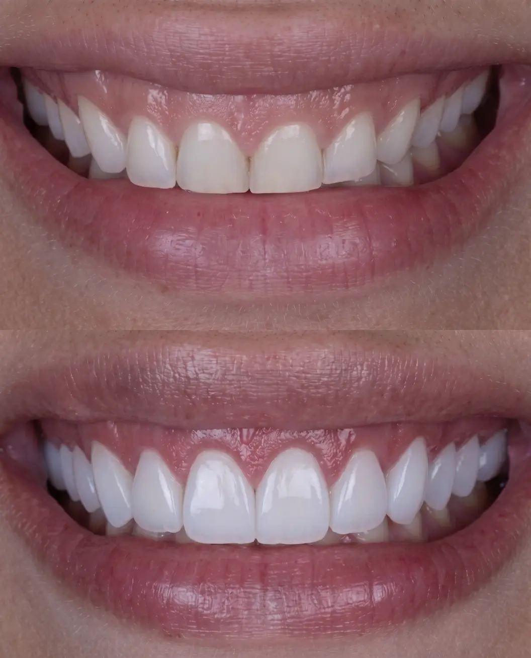 Cosmetic Dental Contouring