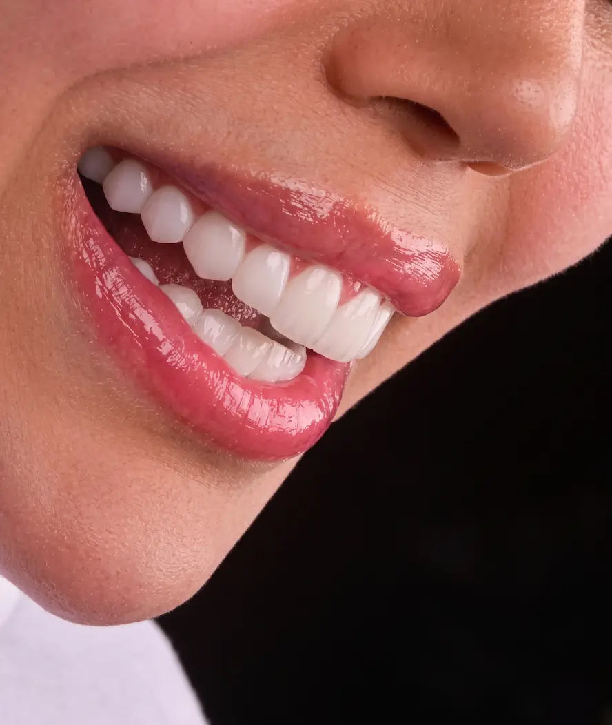 Veneers before and after
