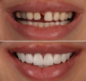 Teeth transformation before and after