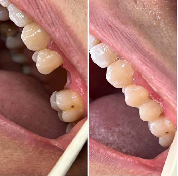 Dental Bridges