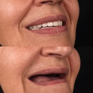 Dentures_before_after