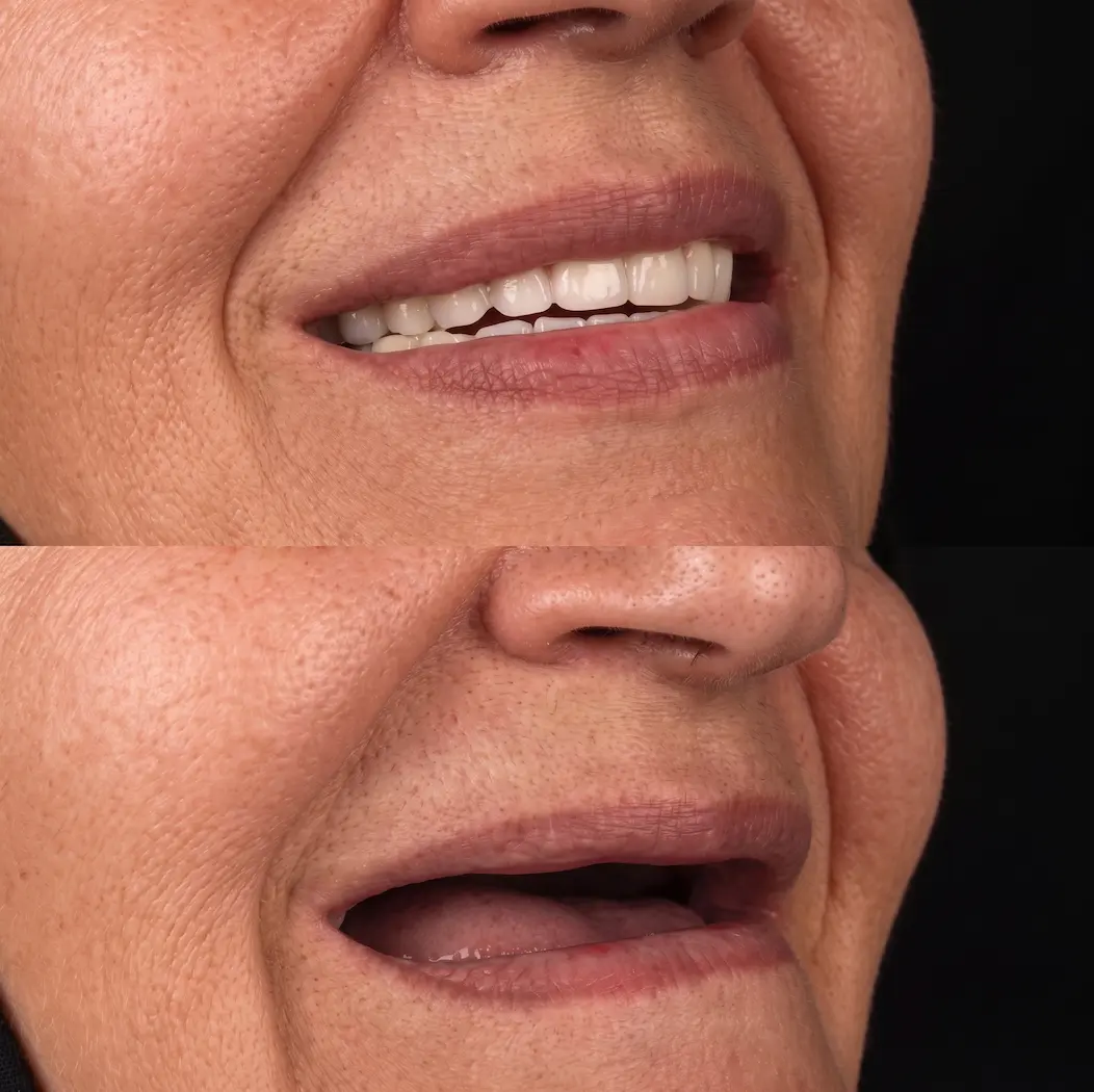 Dentures_before_after