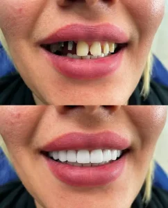 Implants before and after
