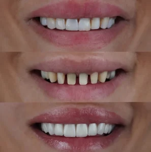 Veneers before and after