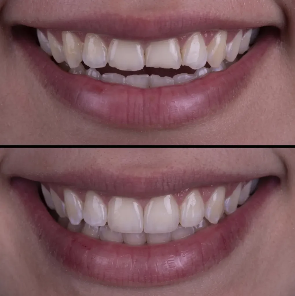 dental bonding before and after