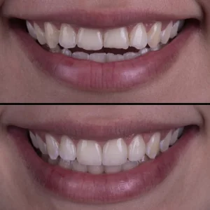 dental bonding before and after