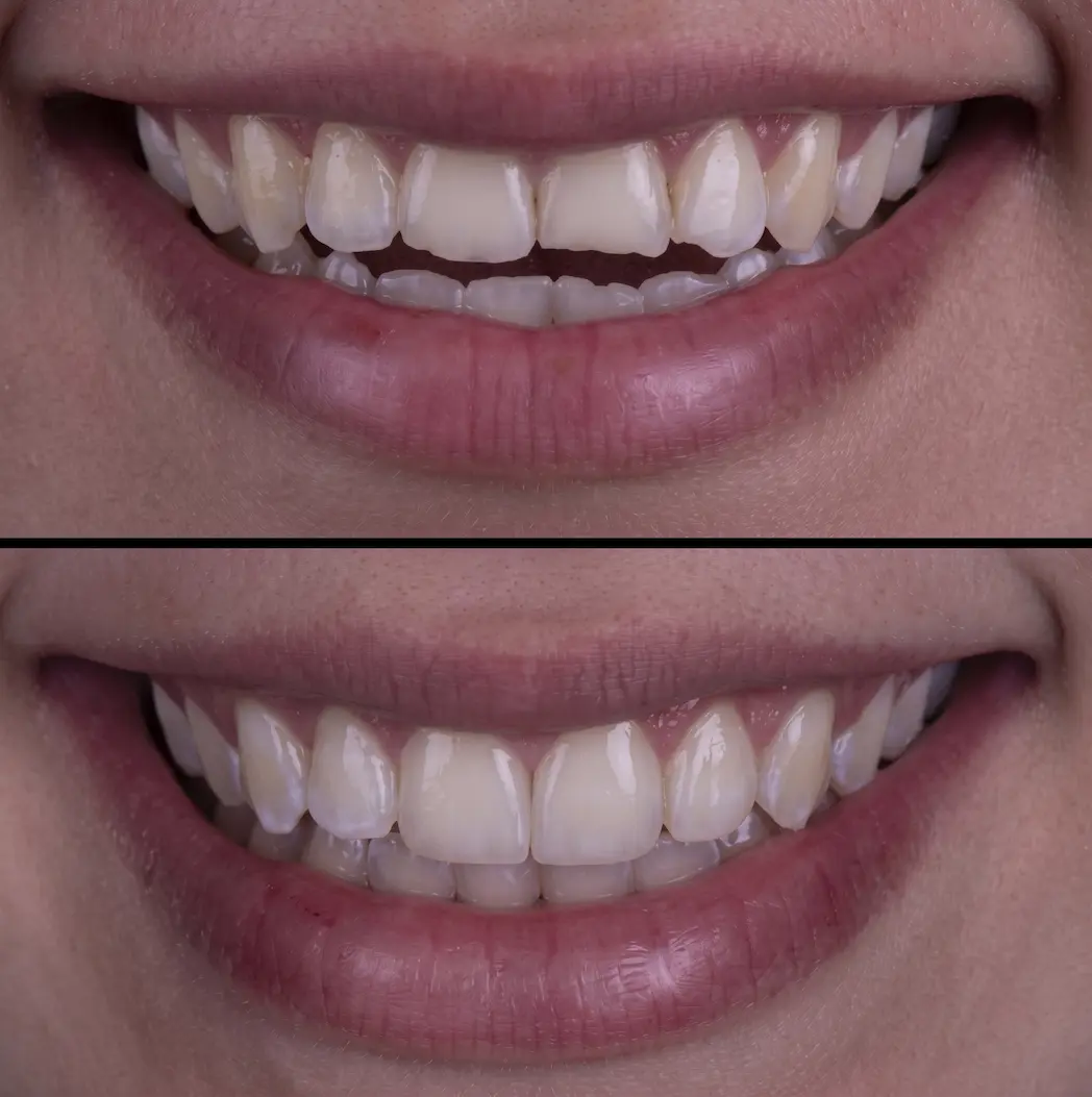 dental bonding before and after