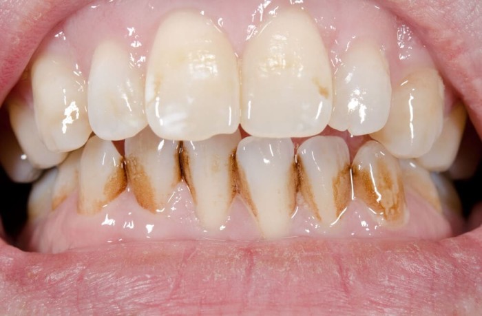 Close-up of extrinsic (surface) brown stains on teeth
