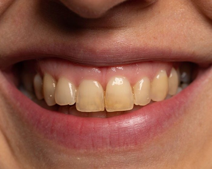 Close-up of intrinsic (deep) brown stains on teeth