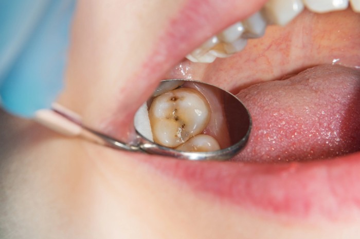 Close-up of tooth decay