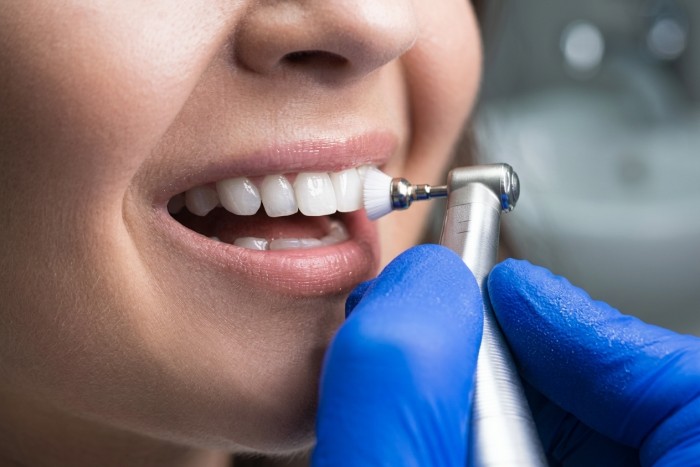 Close-up of dental polishing to treat brown stains on teeth