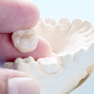 Dental Crowns